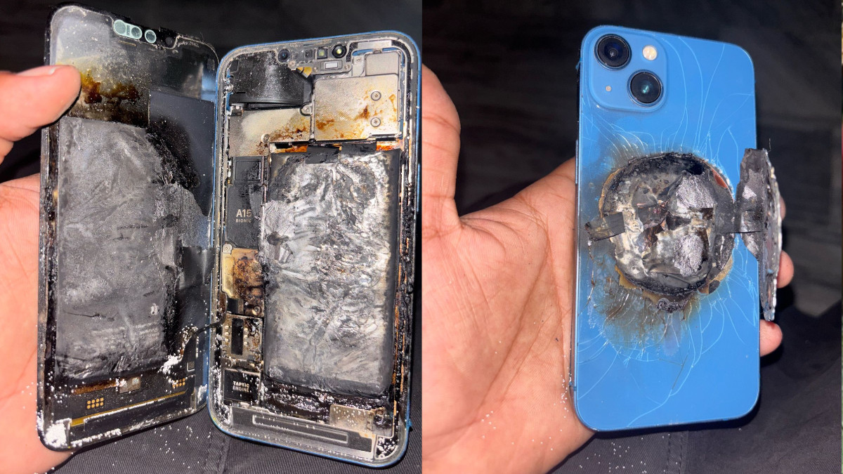 iPhone 13 Explodes in Youth's Pocket, Severely Burned