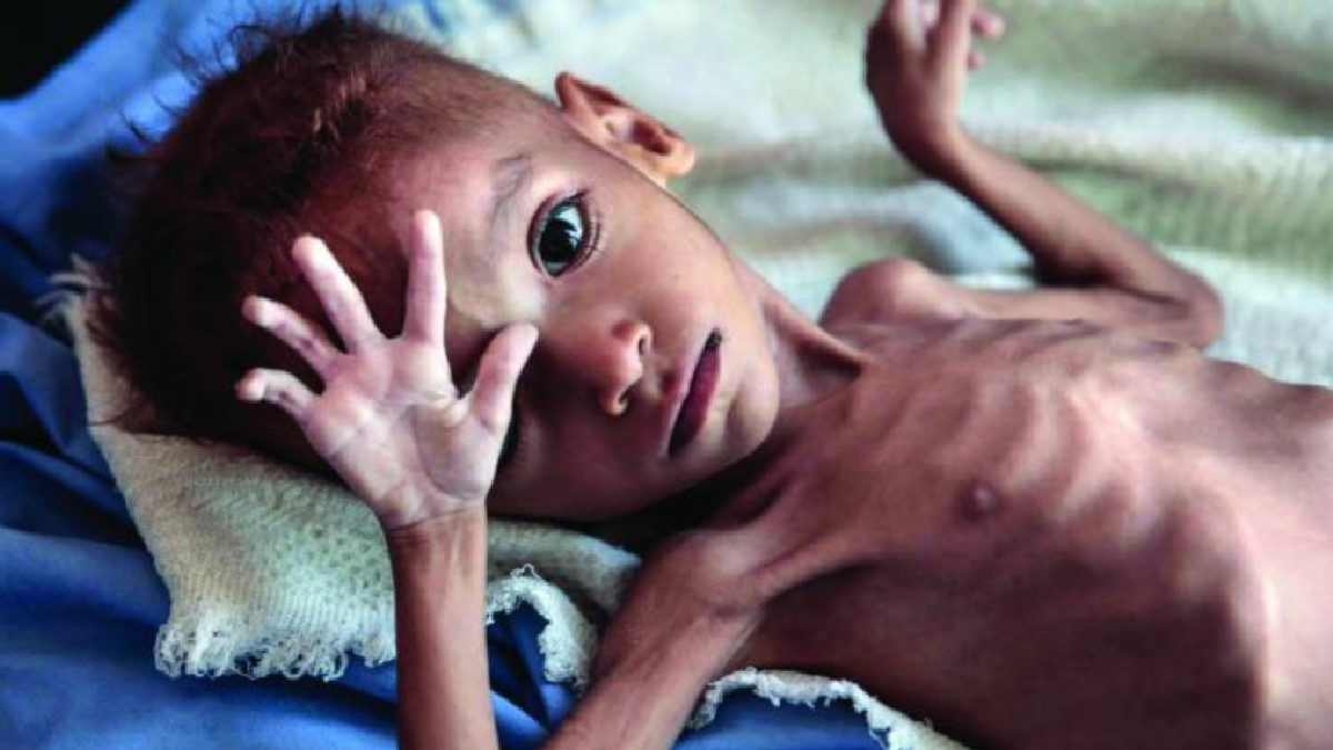 Maharashtra Grapples with Malnutrition: 1.82 Lakh Children Malnourished, Mumbai Suburb Most Affected