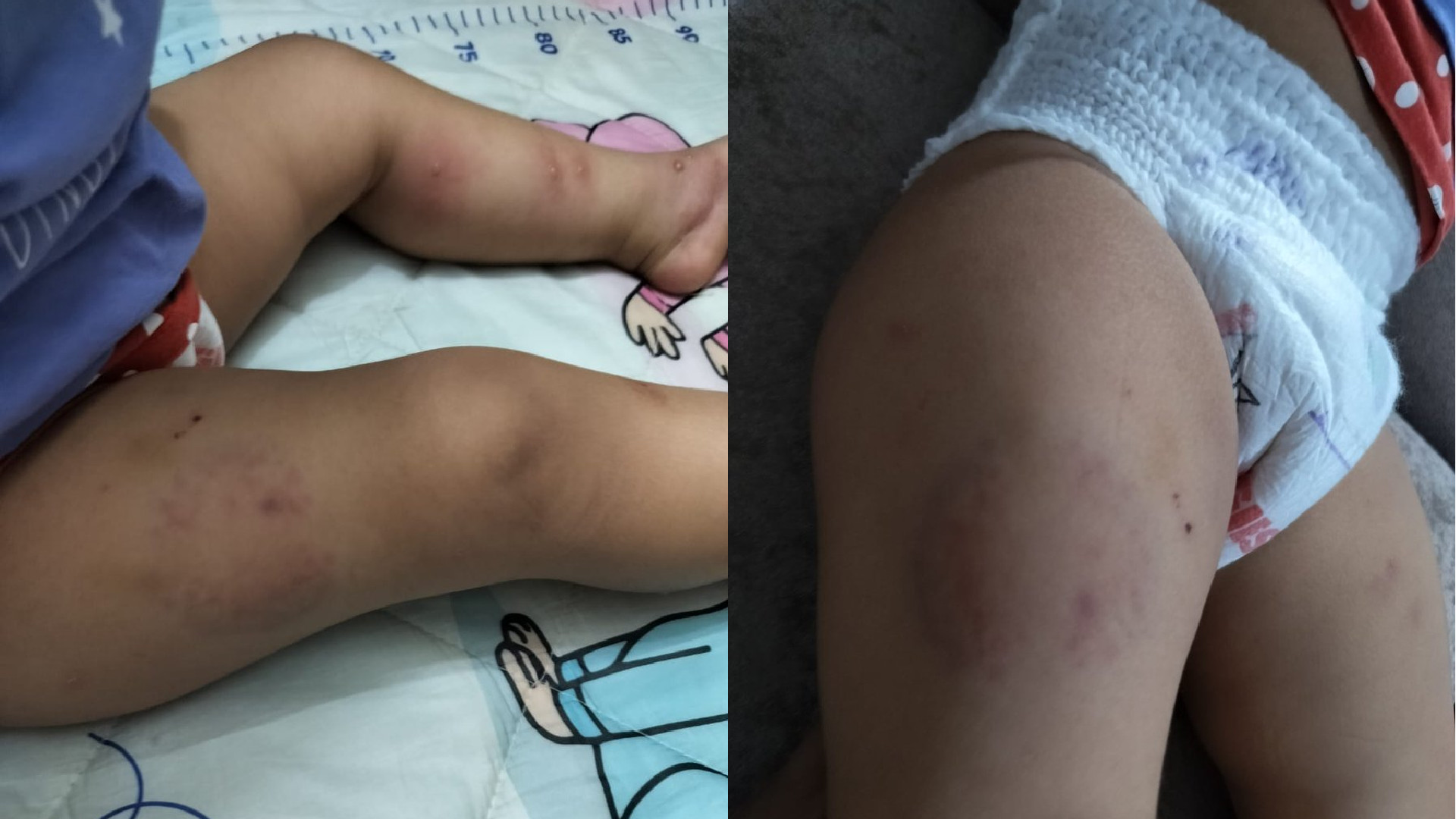 Noida Daycare Worker Arrested for Allegedly Biting and Assaulting a 15-Month-Old Baby